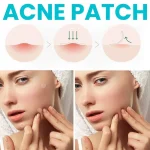 Acne Pimple Patch Invisible - Image 4